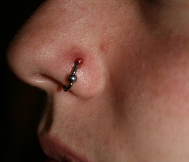 How To Get Rid Of A Small Bump On Your Piercing
